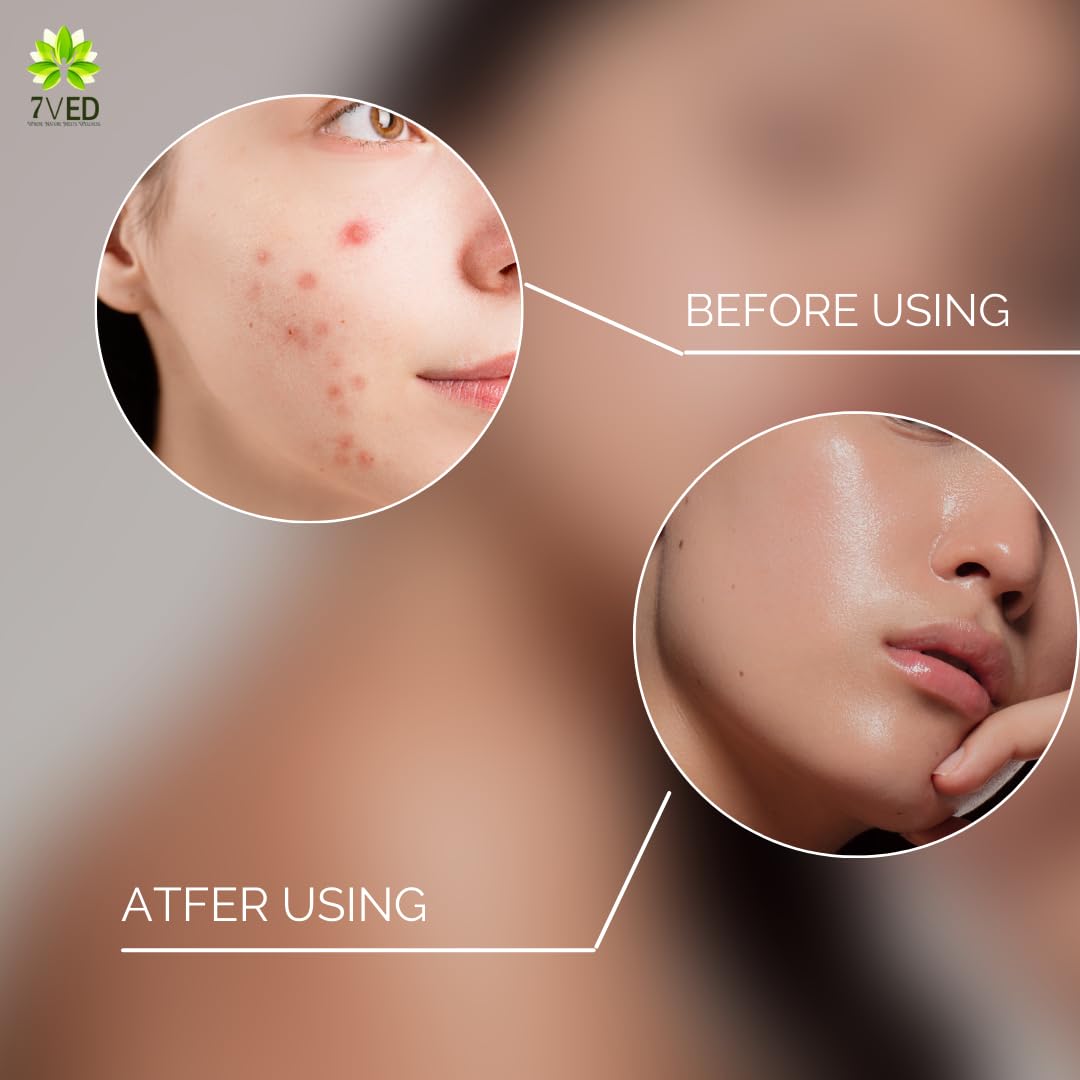 7VED Rice Water Toner For Skin Brighten, Hydrate & Rejuvenate Your Skin Pack of 3 - Zircon Ventures